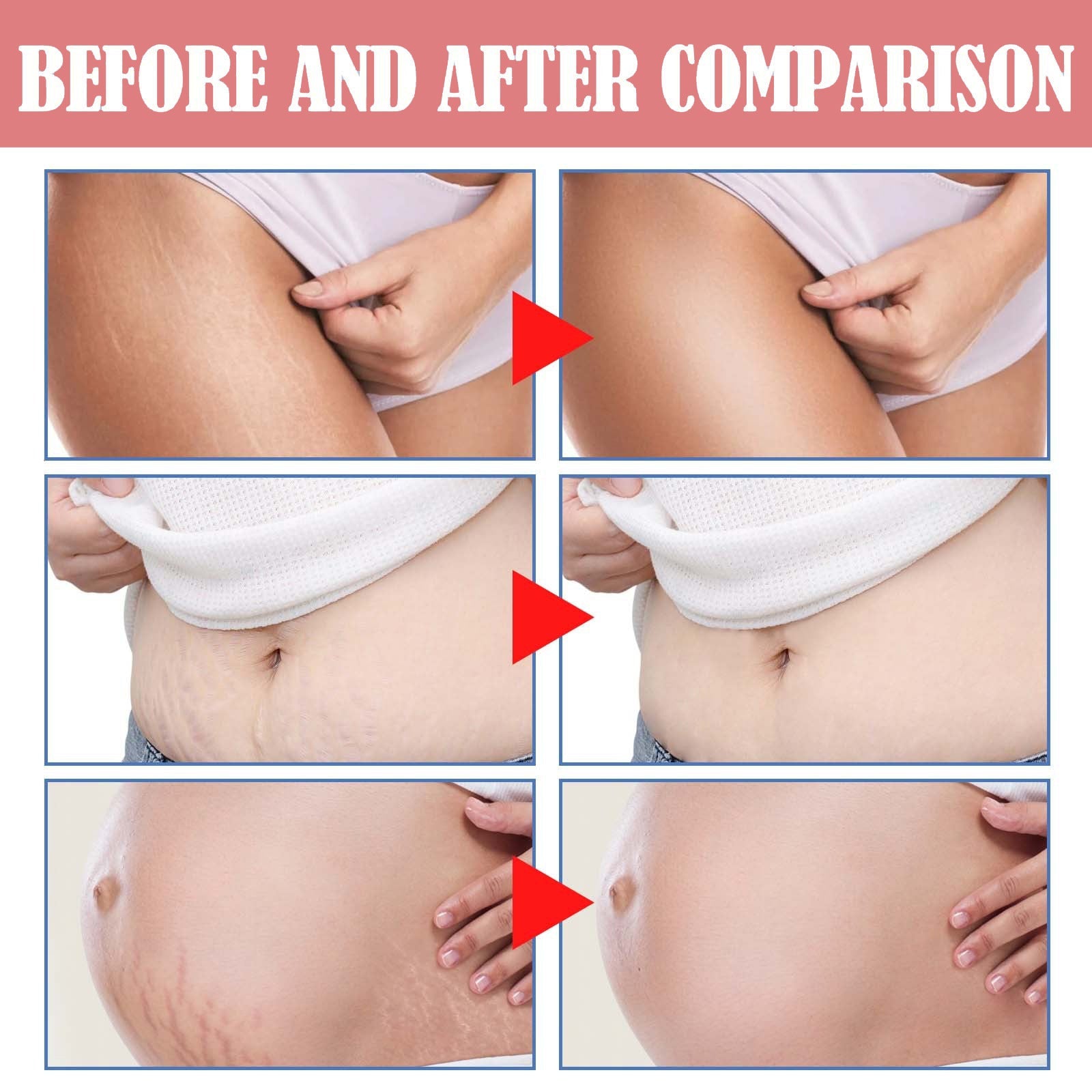 Stretch Mark and Cellulite Repair Balm Cream—Prevents and Fades with Natural Formula of Coconut Oil, Sunflower and Beeswax - GLOWUP