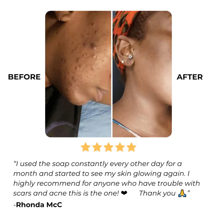 Turmeric Kojic Acid Brightening Soap Cube - 2Pcs Deep Cleansing Bar for Dark Spots & Uneven Skin Tone - GLOWUP