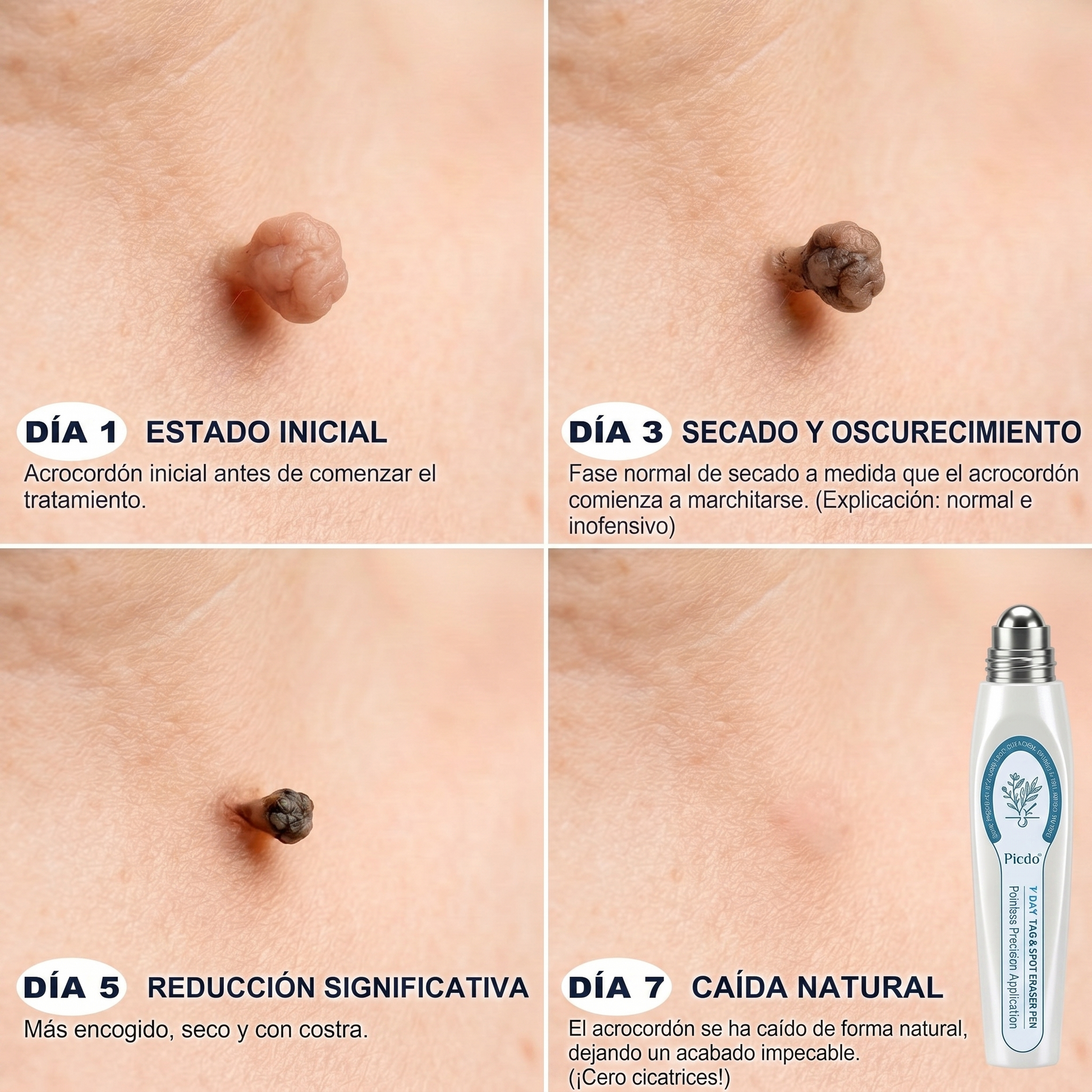 💚7-Day Wart and Spot Remover (Roll-on applicator: no dosage)🍎 - GLOWUP